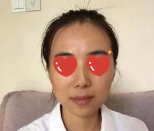 上海美萊醫(yī)生熊師做玻尿酸隆下巴怎么樣，熊師玻尿酸隆下巴案例分享