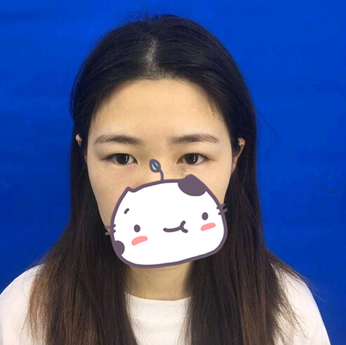 西昌玥美整形專家湯穎峰做雙眼皮怎么樣？湯穎峰雙眼皮案例賞析