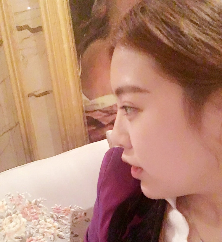 黑龍江藝星醫(yī)生巫文云做鼻部修復(fù)怎么樣，巫文云玻鼻部修復(fù)案例分享