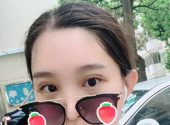 鄭州蕾娜斯彭沖醫(yī)生做微創(chuàng)雙眼皮效果怎么樣？微創(chuàng)雙眼皮案例效果展示