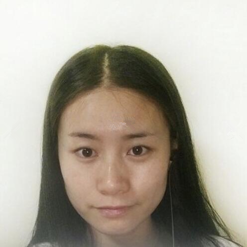 長春銘妍醫(yī)療美容門診部做雙眼皮怎么樣？長春銘妍雙眼皮案例分享