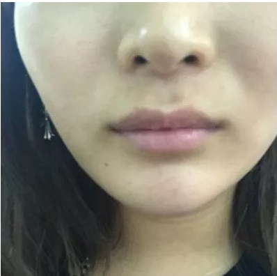 岳陽春天整形專家蔣正華做玻尿酸豐唇怎么樣？蔣正華玻尿酸豐唇案例分享