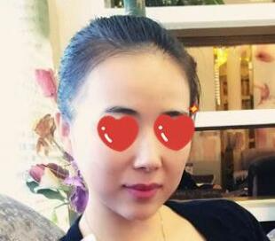 上海美萊醫(yī)生熊師做玻尿酸隆下巴怎么樣，熊師玻尿酸隆下巴案例分享