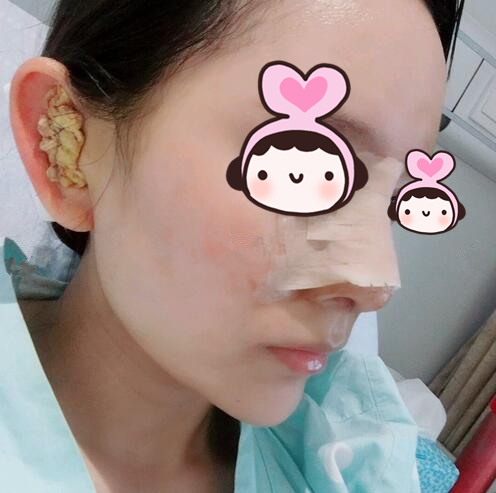 廈門海峽整形專家王翼耕做隆鼻的心得體會，王翼耕做隆鼻效果怎么樣？