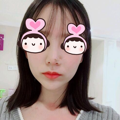 廈門海峽整形專家王翼耕做隆鼻的心得體會，王翼耕做隆鼻效果怎么樣？