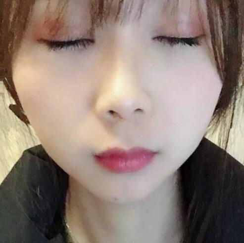 眼綜合整形手術(shù)半個月。