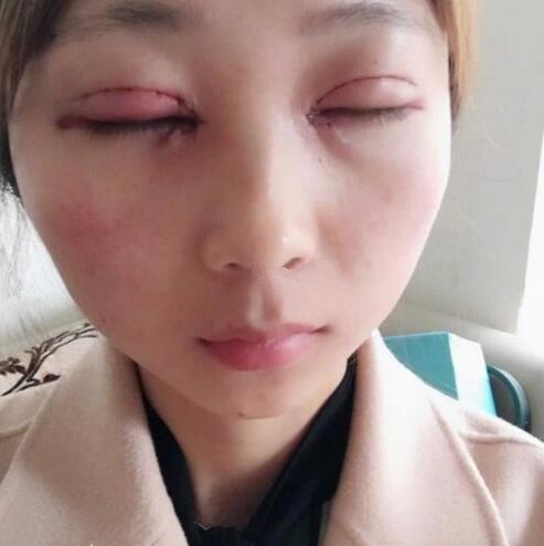 淄博美聯(lián)臣醫(yī)療美容醫(yī)院做切開雙眼皮怎么樣？切開雙眼皮案例分享