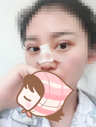 術(shù)后60天效果。