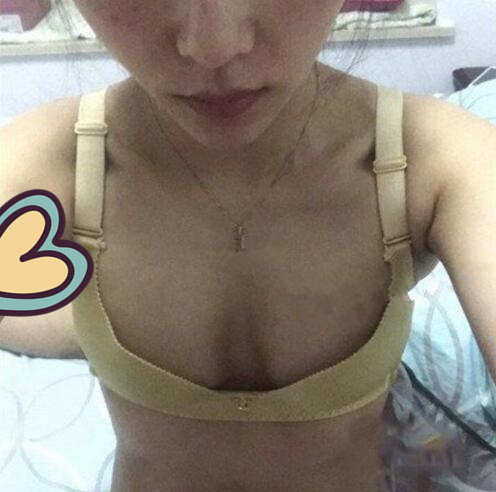 廣州駐顏光醫(yī)療美容診所整形專家劉培做復(fù)合隆胸技術(shù)怎么樣？附案例