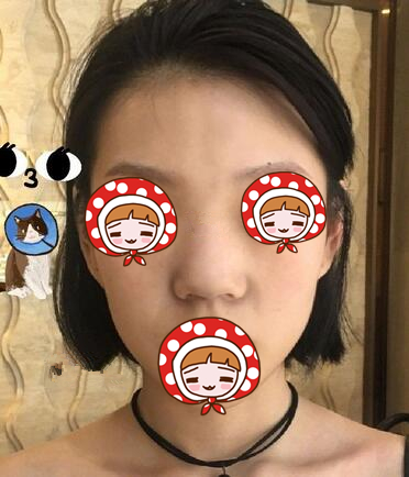 北京京韓醫(yī)療美容診所做硅膠隆鼻效果怎么樣？北京京韓醫(yī)療硅膠隆鼻案例
