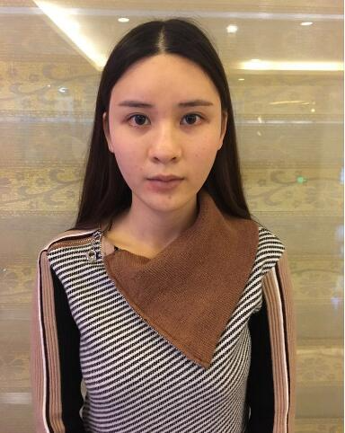 北京藝星整形專家郭峰做假體隆鼻修復(fù)怎么樣？郭峰假體隆鼻修復(fù)案例