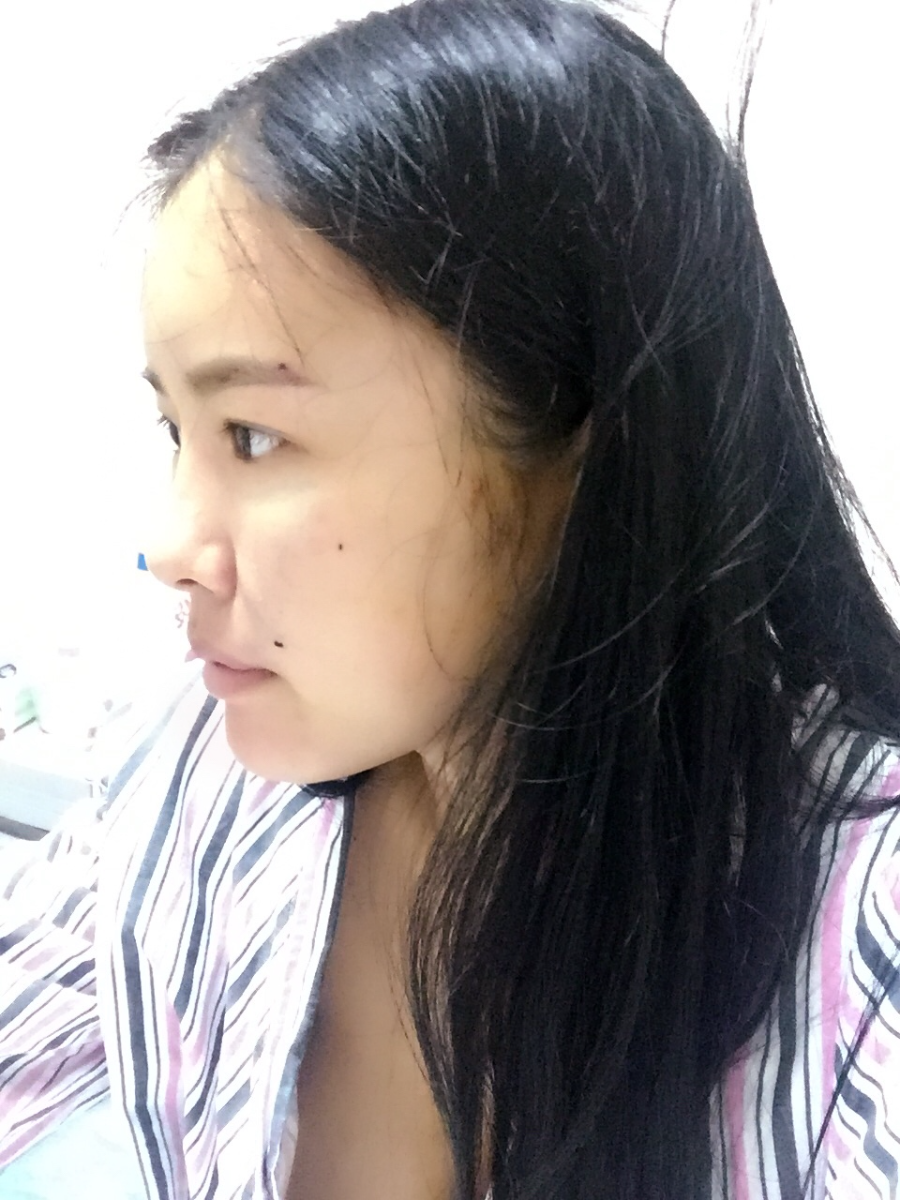 西安莎曼妃醫(yī)療美容醫(yī)院醫(yī)生樸俊做自體脂肪豐太陽穴效果怎么樣？