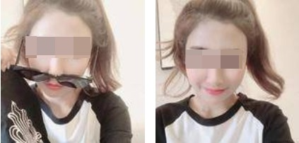 昆明麗都整形醫(yī)生孟春麗做面部自體脂肪填充效果怎么樣？