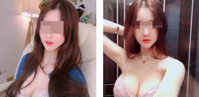 沈陽杏林整形美容醫(yī)院崔昌墉醫(yī)生做假體隆胸技術怎么樣？附案例