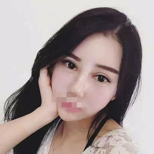東莞維多利亞做硅膠隆鼻怎么樣？整形醫(yī)生李剛硅膠隆鼻案例分享