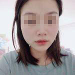 濟南曹博士美容整形醫(yī)院做玻尿酸豐面頰怎么樣？陳正喜醫(yī)生案例