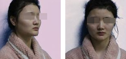上海新健威醫(yī)療整形醫(yī)生錢(qián)成寶做肋軟骨隆鼻+自體脂肪全臉填充案例