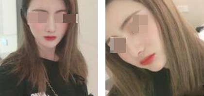 術后照片