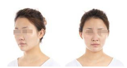 蘭州美月整形美容醫(yī)院文輝才醫(yī)生做鼻綜合整形效果怎么樣？附鼻綜合案例