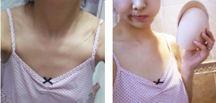 沈陽杏林整形美容醫(yī)院崔昌墉醫(yī)生做假體隆胸技術怎么樣？附案例