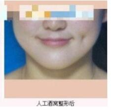 德州市第二人民醫(yī)院燒傷美容整形科張波濤醫(yī)生做酒窩成形術(shù)怎么樣？