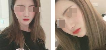 上海新健威醫(yī)療整形醫(yī)生錢(qián)成寶做肋軟骨隆鼻+自體脂肪全臉填充案例