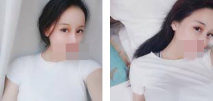 寧波美仁整形美容醫(yī)院李英大醫(yī)生做切開雙眼皮效果怎么樣？