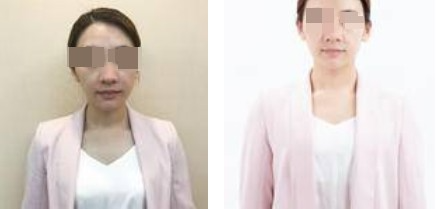 上海攸維醫(yī)療美容診所整形醫(yī)生李靜做膨體隆鼻效果怎么樣？附案例展示