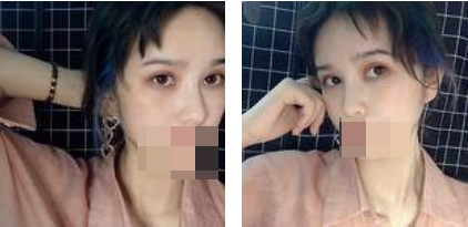 做了切開雙眼皮手術(shù)，才發(fā)現(xiàn)自己原來可以這么美！