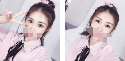 沒有了眼袋困擾，身體和心態(tài)都年輕了十歲