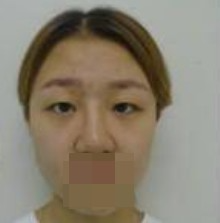 做了全切雙眼皮不僅外表變美了，內(nèi)心也更加自信了