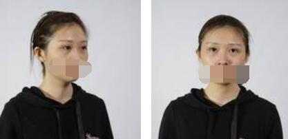 沒有了眼袋困擾，身體和心態(tài)都年輕了十歲