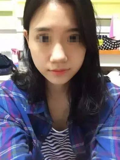 做完膨體隆鼻，鼻子變“挺”了