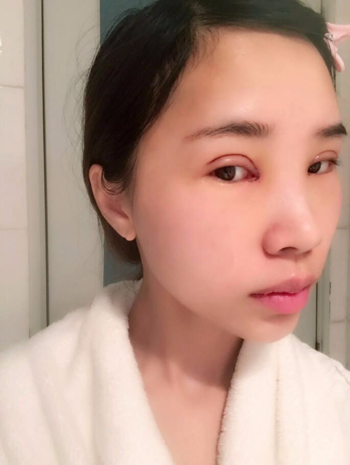 合肥艾雅整形美容醫(yī)院醫(yī)生楊海平做雙眼皮手術(shù)怎么樣？楊海平雙眼皮手術(shù)案例