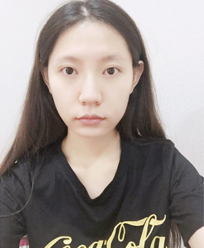  濟(jì)南安美醫(yī)療整形醫(yī)生李思思做下頜角整形怎么樣？李思思下頜角整形案例