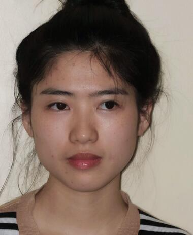 北京彤美整形醫(yī)院趙彤醫(yī)生做下頜角整形怎么樣？下頜角整形案例展示