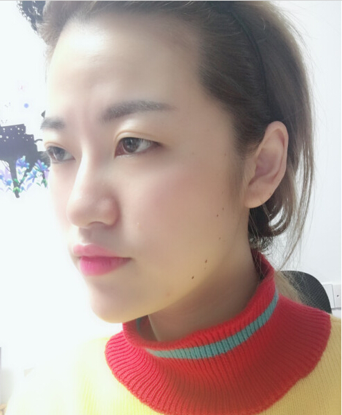 成都藝星醫(yī)療美容醫(yī)院陳遠琨醫(yī)生做注射肉毒素瘦臉效果怎么樣？附案例