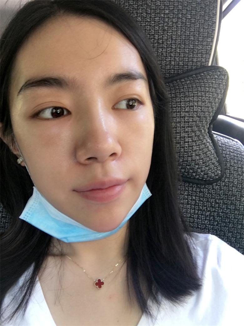 合肥壹加壹整形美容醫(yī)院做祛眼袋效果怎么樣？金大生祛眼袋案例分享