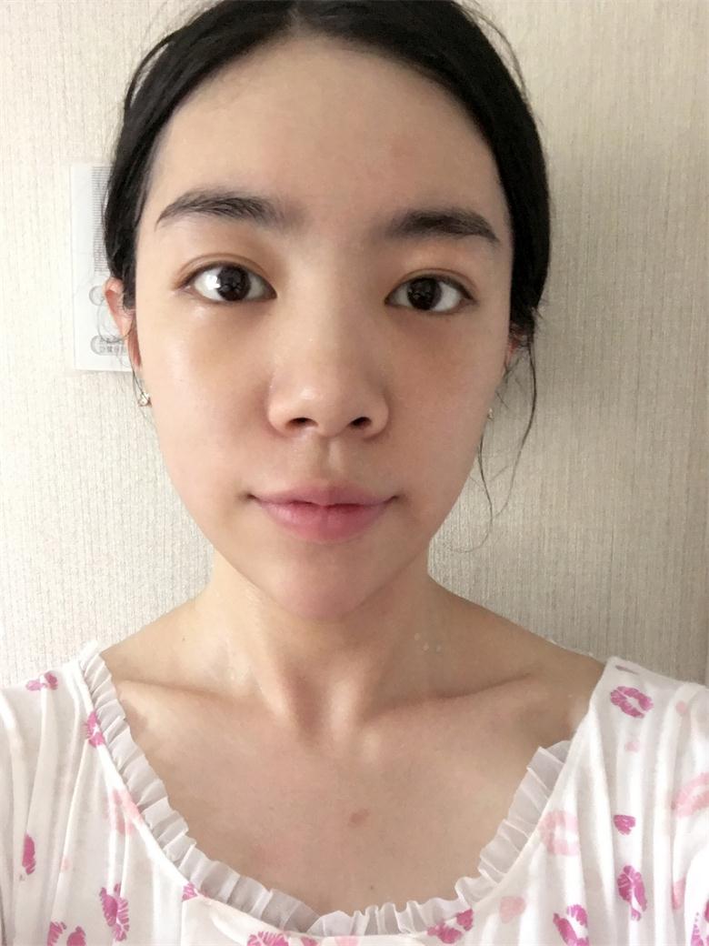 合肥壹加壹整形美容醫(yī)院做祛眼袋效果怎么樣？金大生祛眼袋案例分享