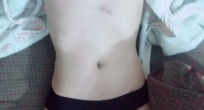 深圳晨曦整形醫(yī)院吉米斯做腰腹吸脂怎么樣？附吉米斯醫(yī)生腰腹吸脂案例