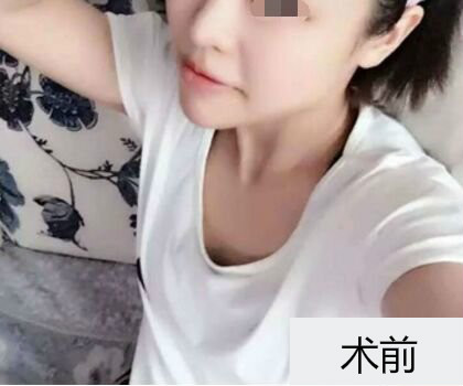 深圳博美整形醫(yī)生劉超做自體脂肪隆胸怎么樣？自體脂肪隆胸案例