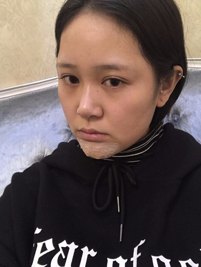 青島集美整形醫(yī)院做硅膠墊下巴怎么樣？趙煜楠醫(yī)生硅膠墊下巴真人案例