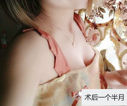 深圳博美整形醫(yī)生劉超做自體脂肪隆胸怎么樣？自體脂肪隆胸案例
