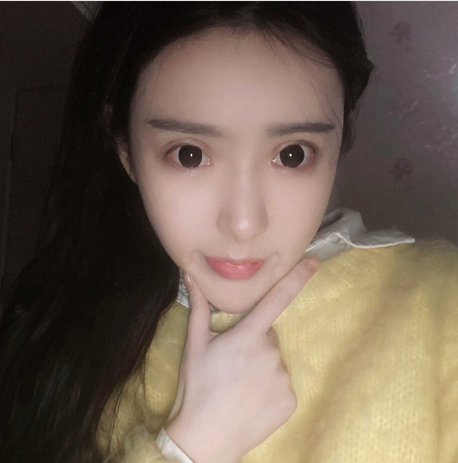 重慶柏漫醫(yī)療美容診所高紅艷醫(yī)生做面部吸脂怎么樣？面部吸脂案例分享