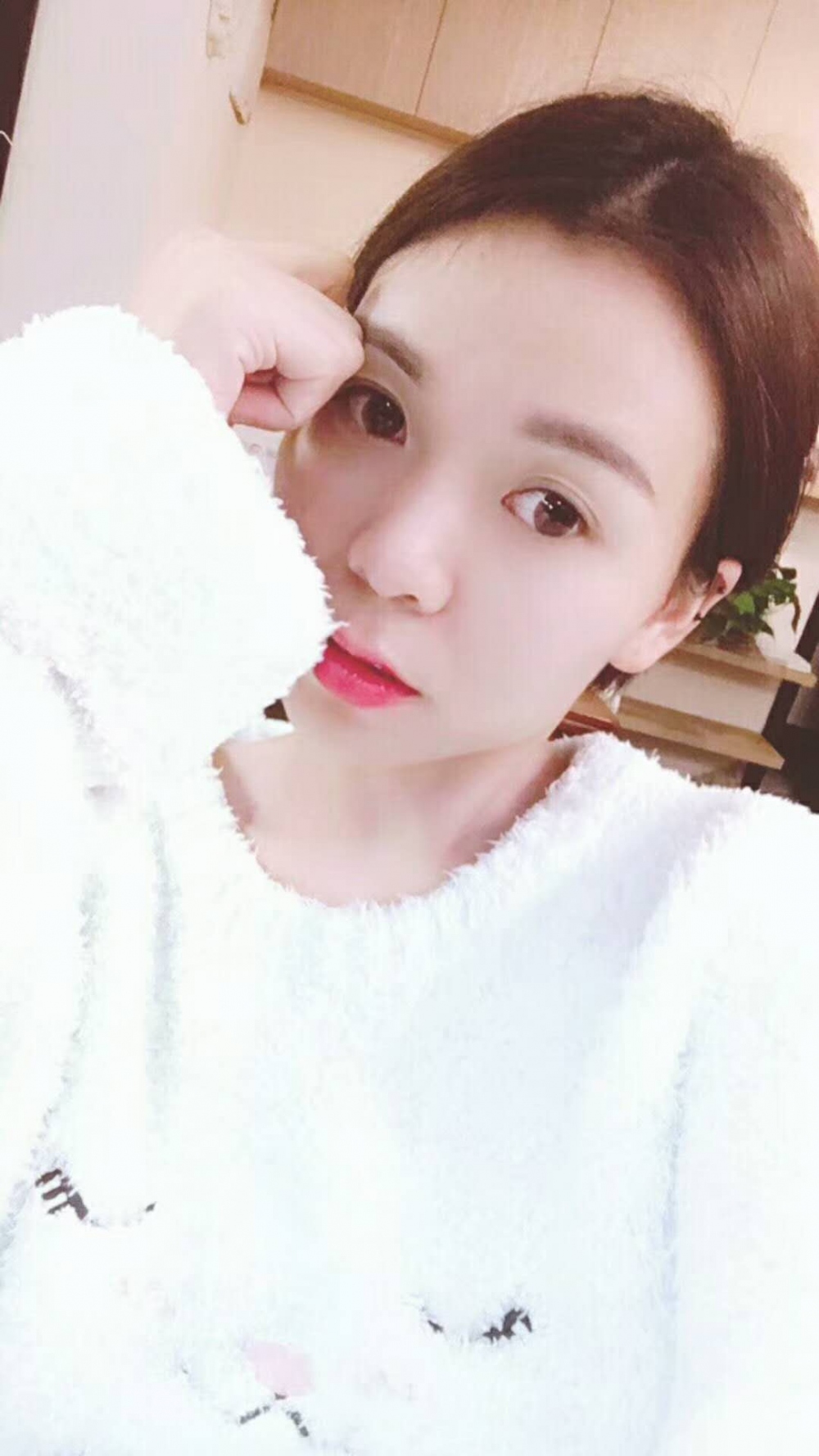 長沙星雅醫(yī)療美容醫(yī)院做埋線提升去法令紋效果怎么樣？附金振玉醫(yī)生案例