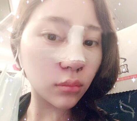 蘇州明基醫(yī)院醫(yī)療美容科做鼻綜合整形怎么樣？蘇州明基鼻綜合整形案例