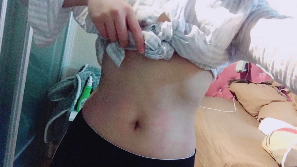 深圳晨曦整形醫(yī)院吉米斯做腰腹吸脂怎么樣？附吉米斯醫(yī)生腰腹吸脂案例