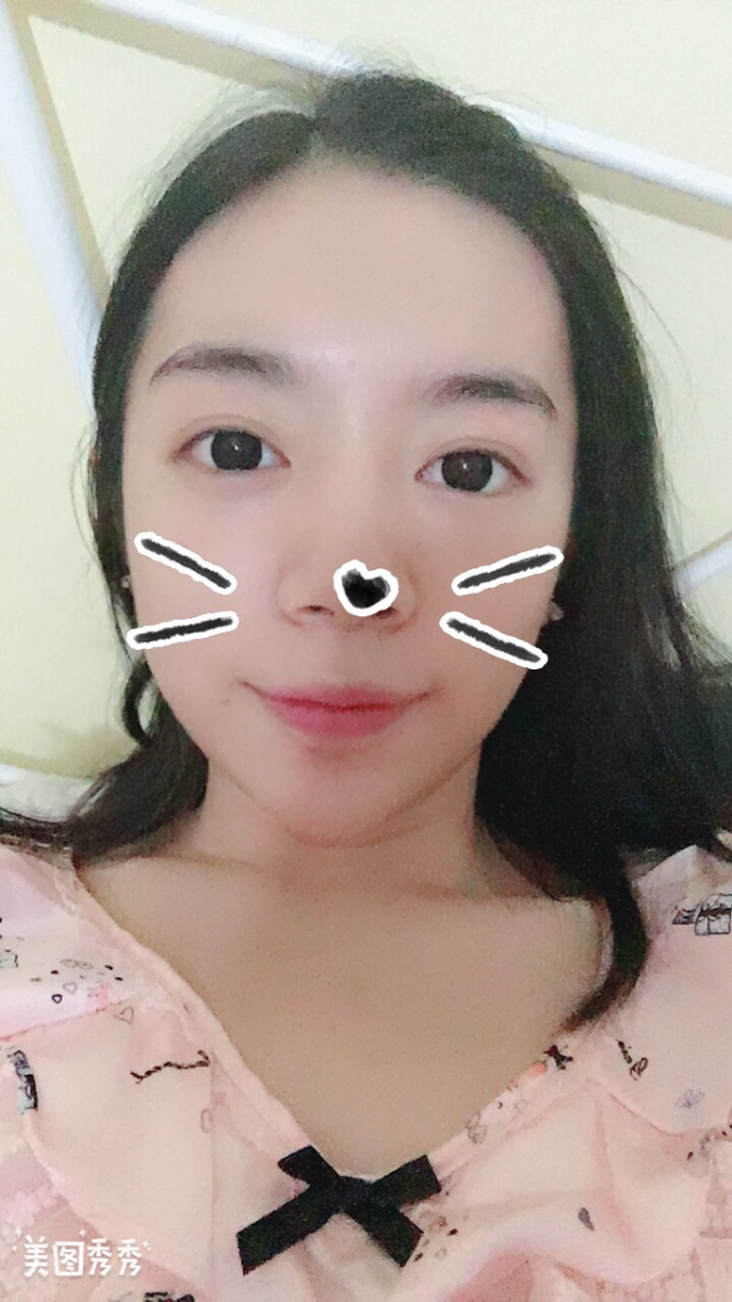 合肥壹加壹整形美容醫(yī)院做祛眼袋效果怎么樣？金大生祛眼袋案例分享