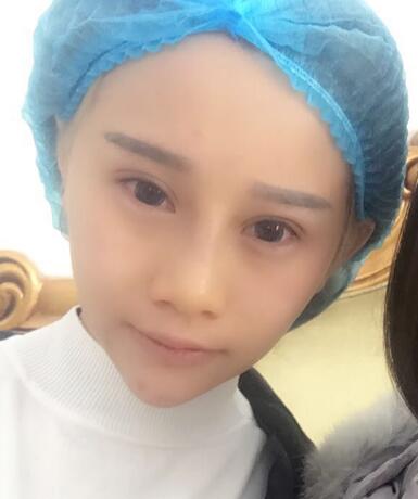 長春奧拉克美容醫(yī)院金相勛醫(yī)生做玻尿酸豐臥蠶怎么樣？附案例