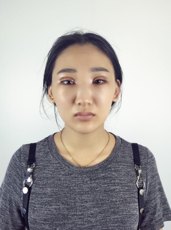 武漢中翰整形外科醫(yī)院沈磊醫(yī)生做切開雙眼皮怎么樣？附沈磊切開雙眼皮案例